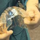 Mulher recebe transplante de crânio feito com impressora 3D