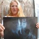 Dona de casa descobre tesoura no abdome 25 anos após cirurgia