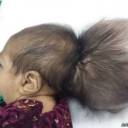 Médicos removem ‘segunda cabeça’ de bebê no Afeganistão